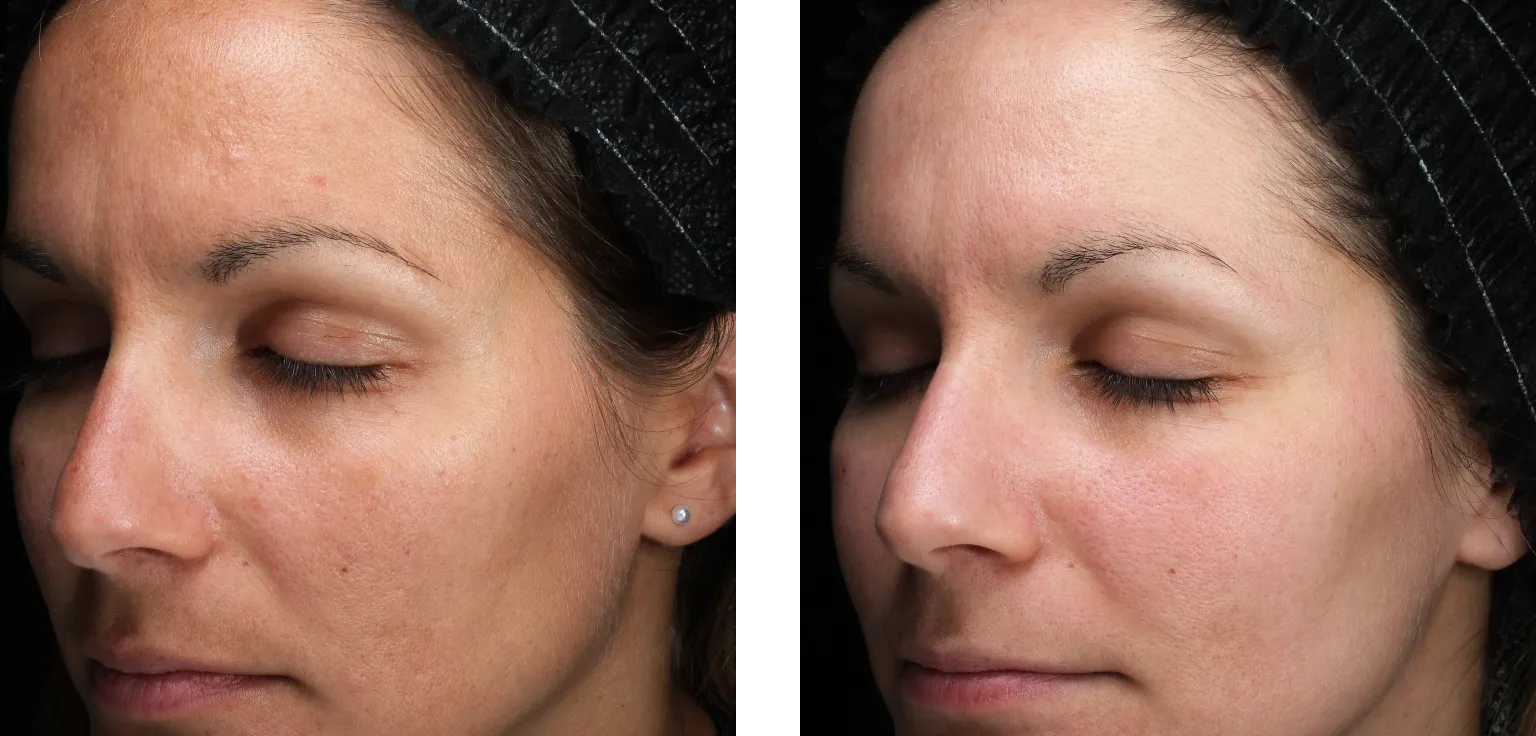 MOXI laser before and after — improved skin tone and texture