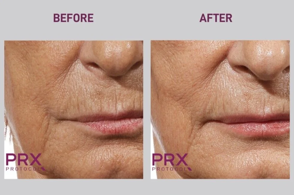 PRX Protocol before and after — perioral wrinkle smoothing