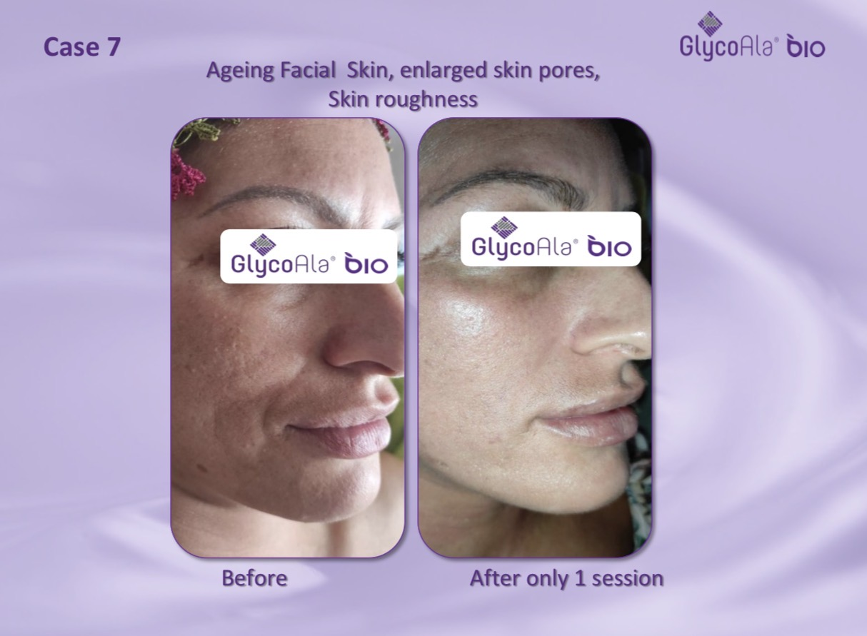 GlycoAla Bio before and after — ageing skin, enlarged pores and roughness after one session