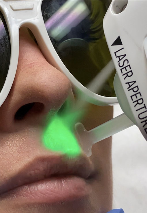 Illuminate Laser Facial with Clarity II