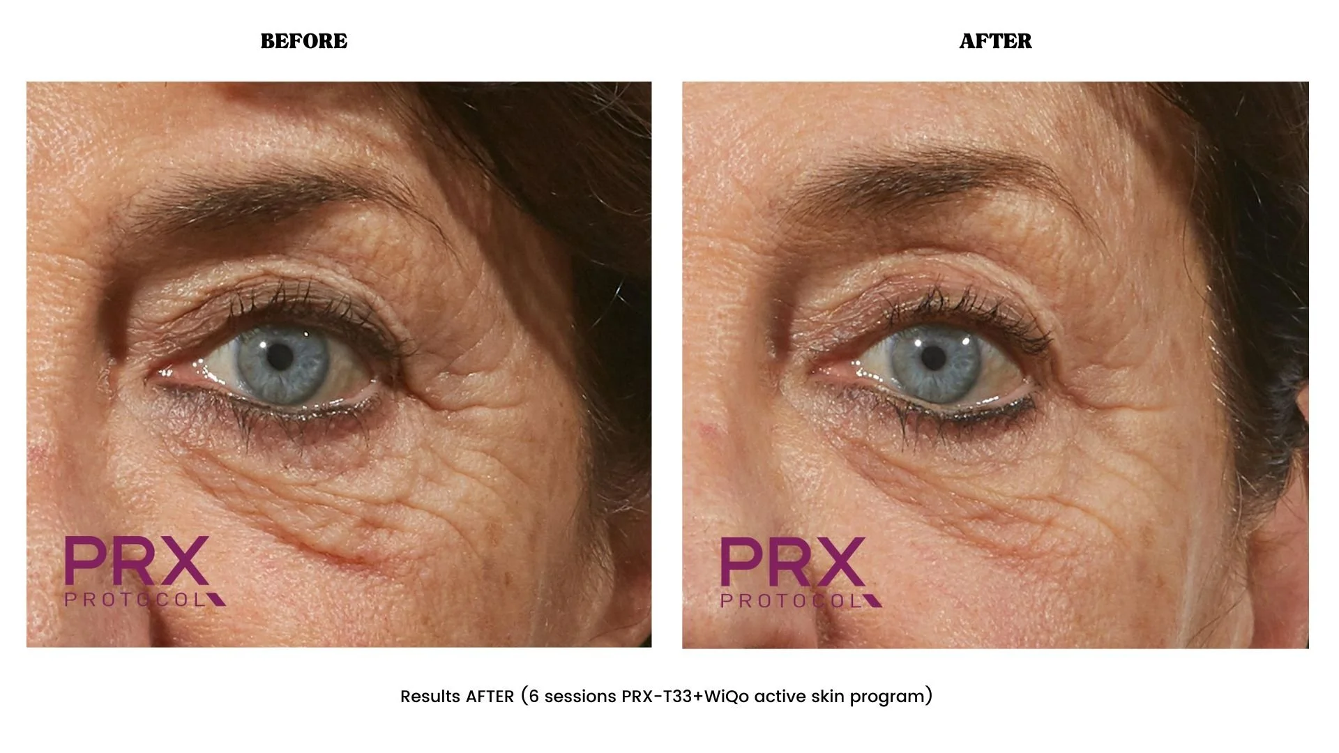 PRX Protocol before and after — 6 sessions, periorbital renewal