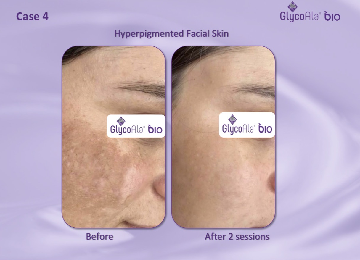 GlycoAla Bio before and after — hyperpigmented facial skin after two sessions