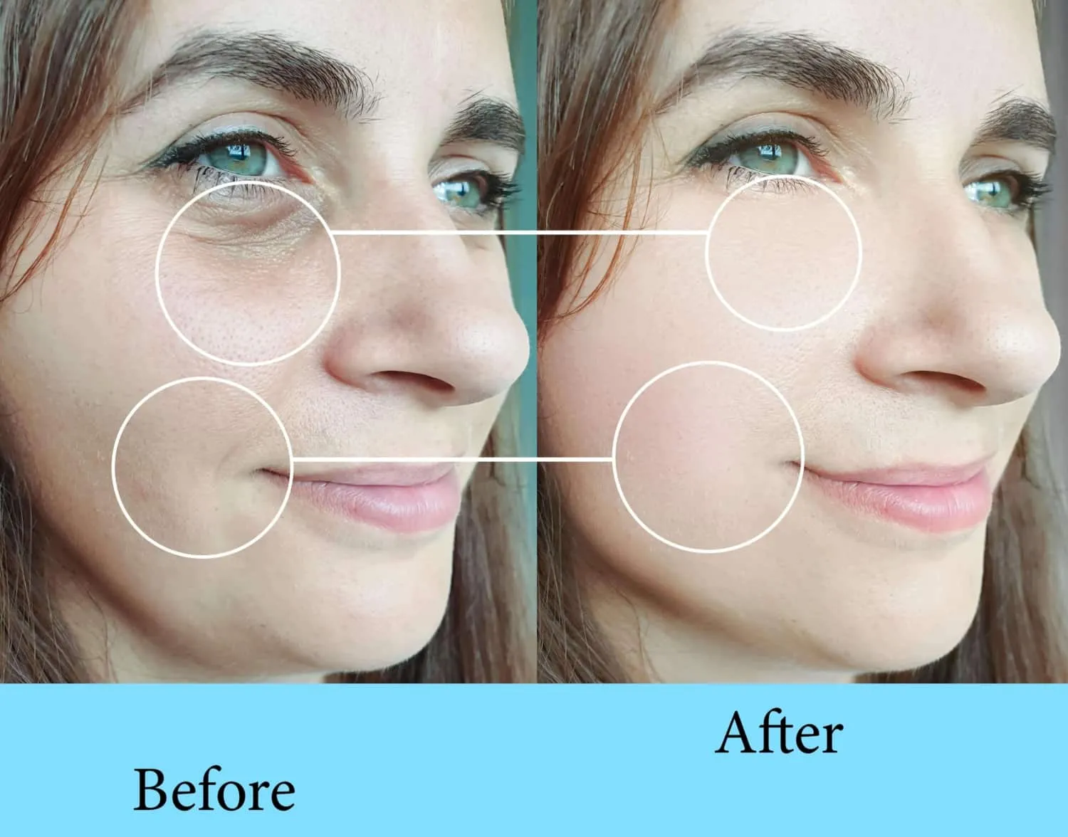PRX before and after — under-eye and nasolabial refinement