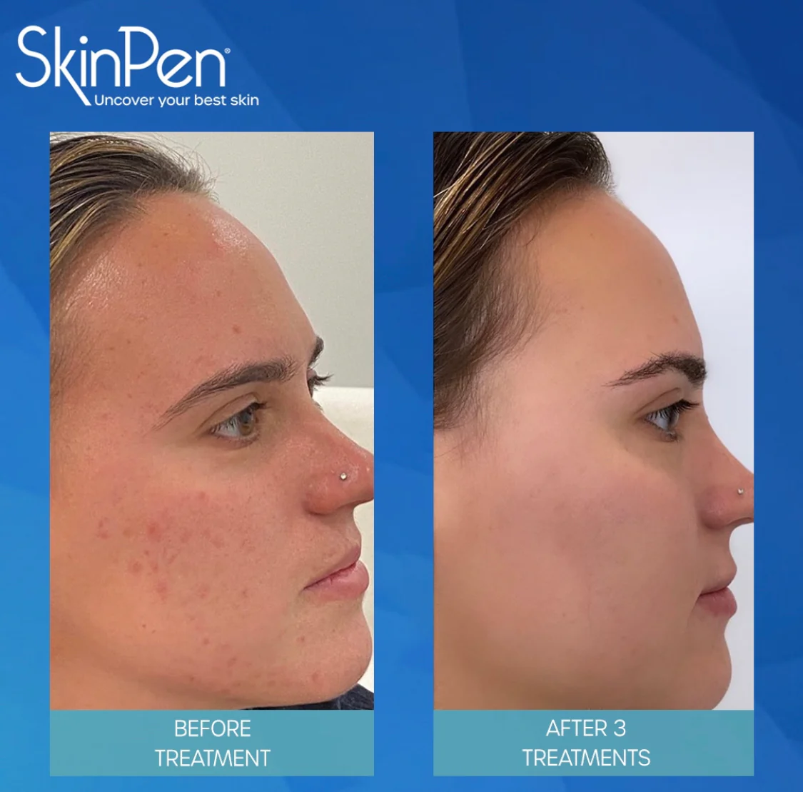 SkinPen before and after — 3 treatments, skin clarity and tone