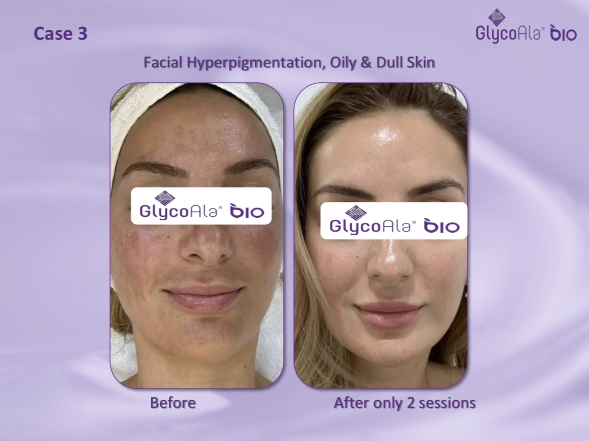 GlycoAla Bio before and after — facial hyperpigmentation, oily and dull skin after two sessions