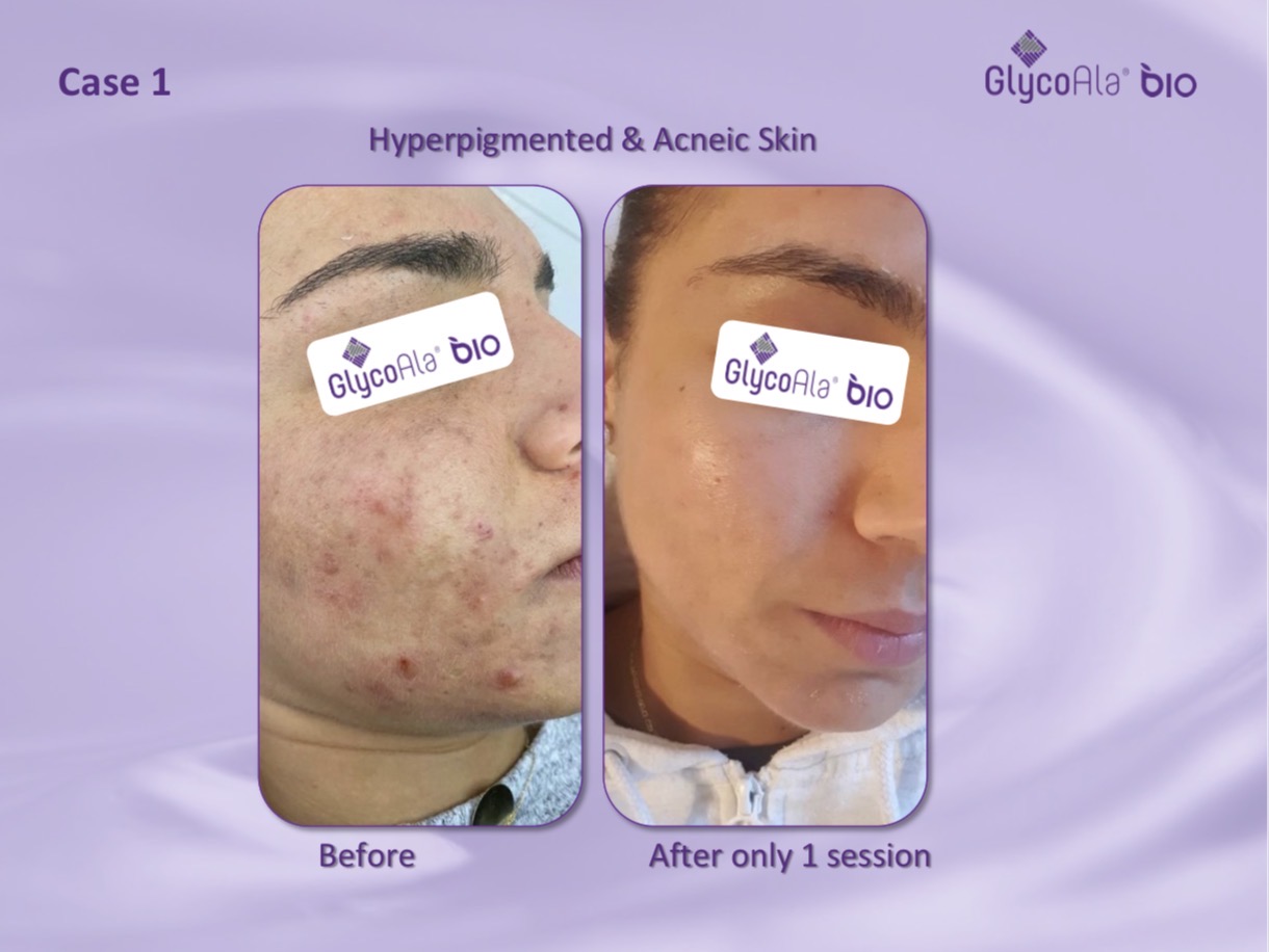 GlycoAla treatment detail