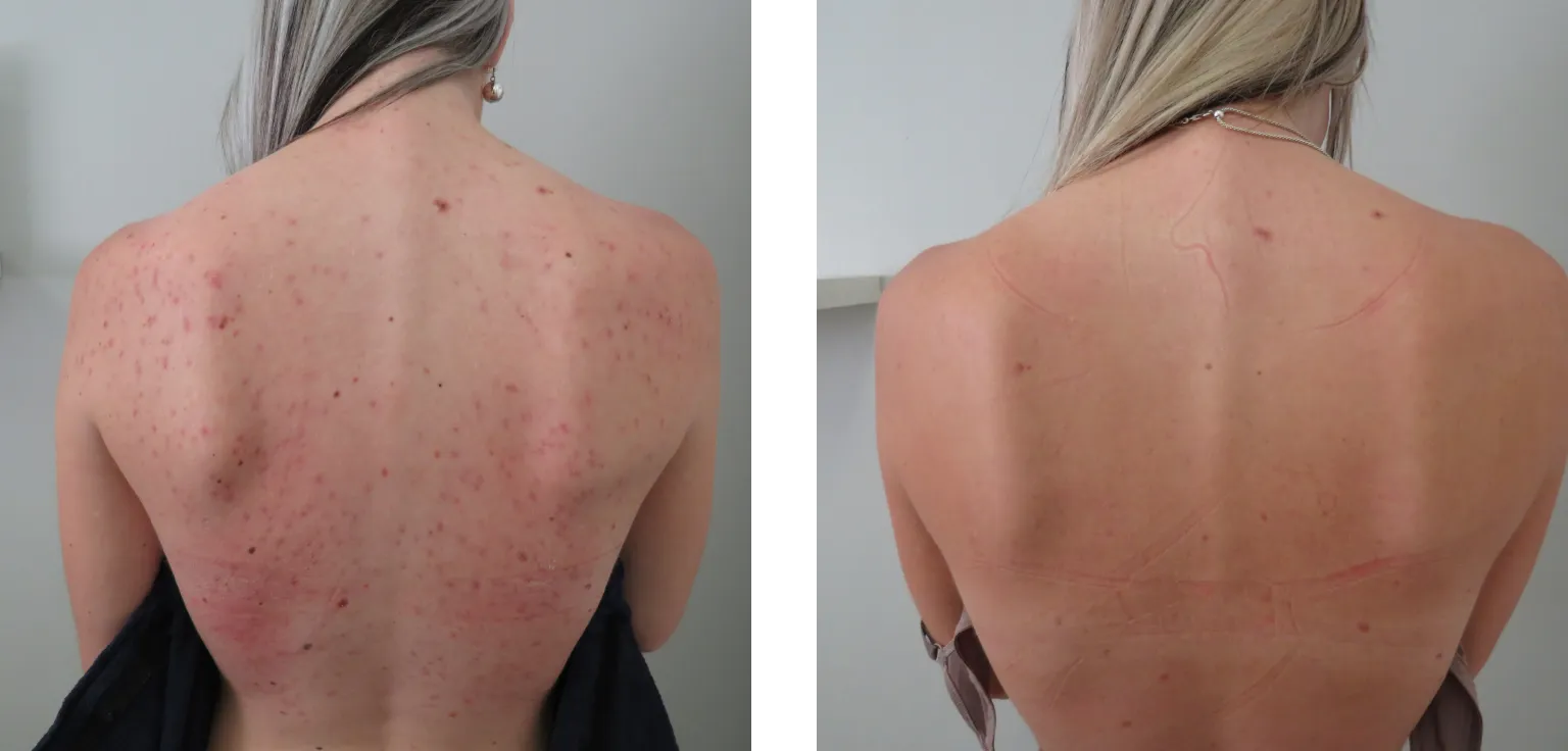 BBL before and after — back acne and discoloration clearing