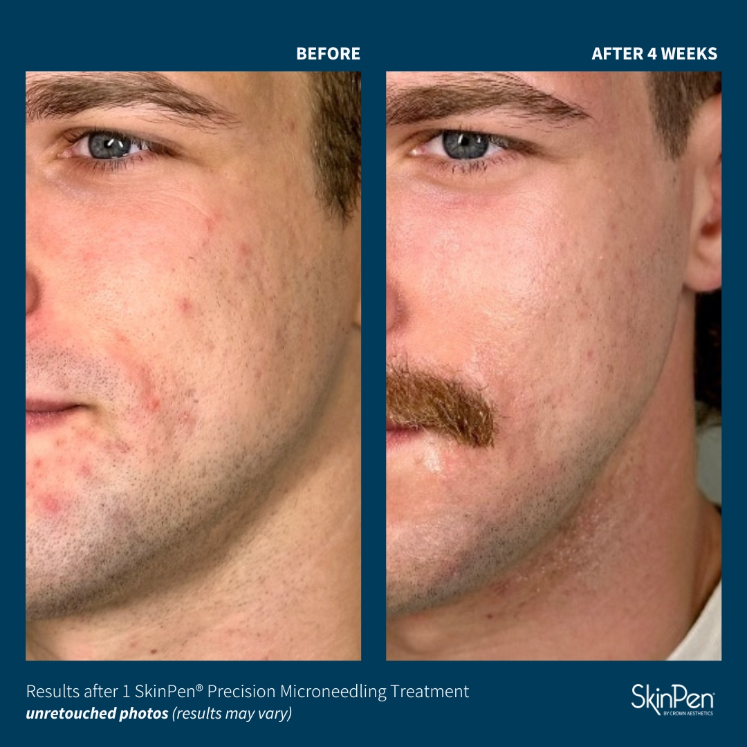 SkinPen before and after — 4 weeks post one treatment