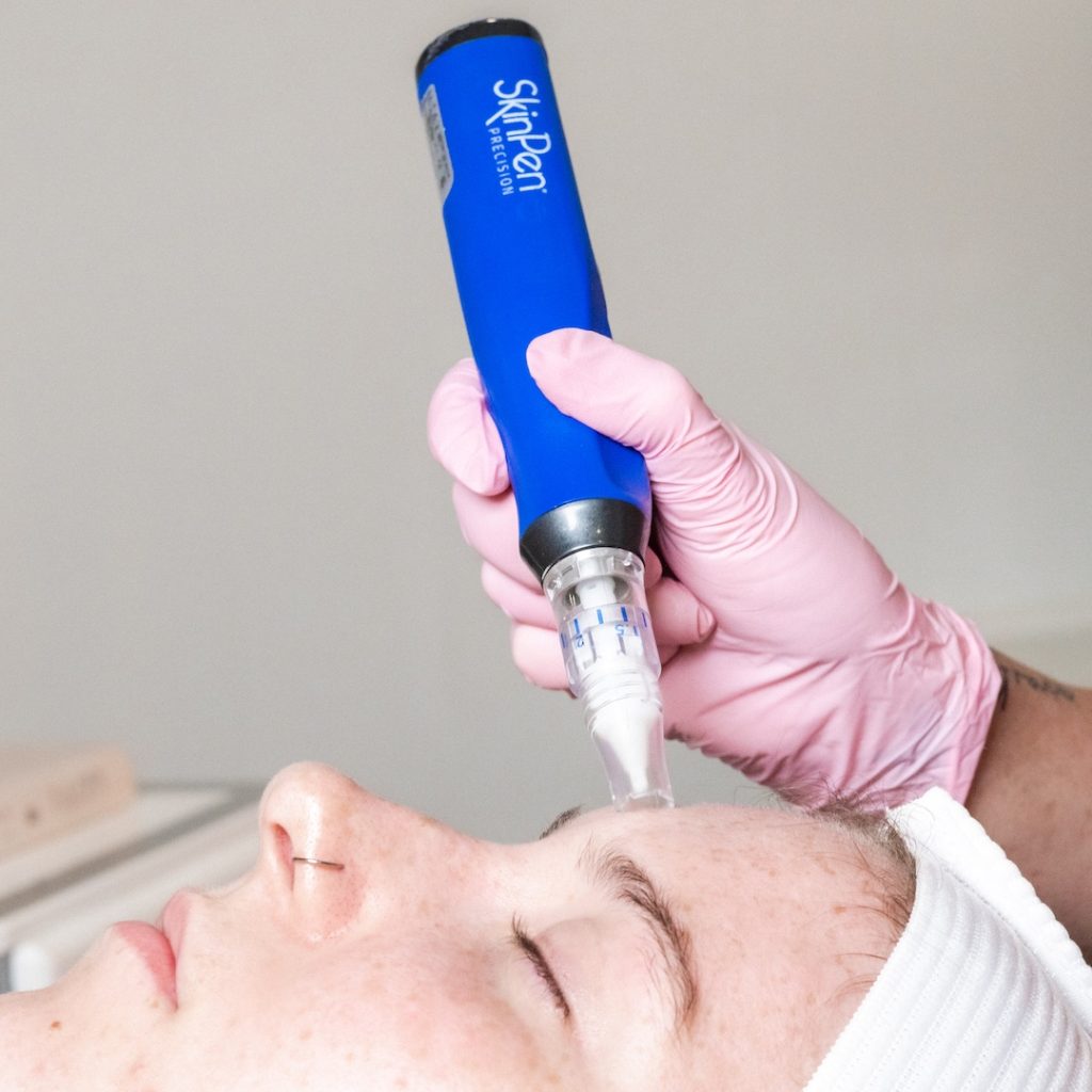 Zohar provider performing SkinPen Precision Elite microneedling