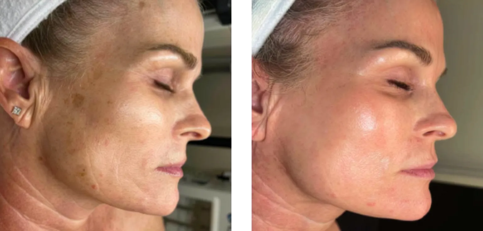 MOXI laser before and after — reduced sun damage and pigmentation