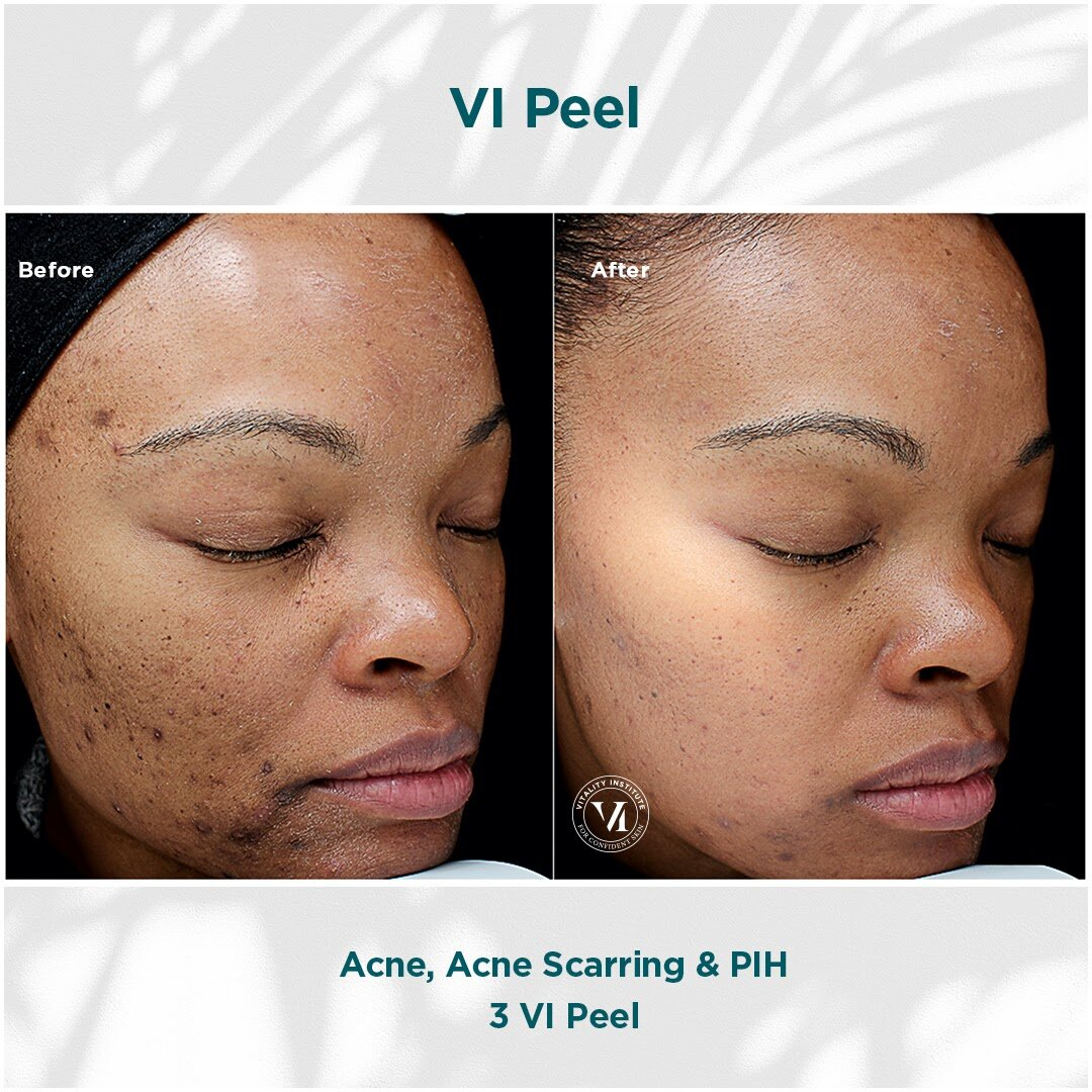 VI Peel before and after — acne, acne scarring & PIH after 3 VI Peels