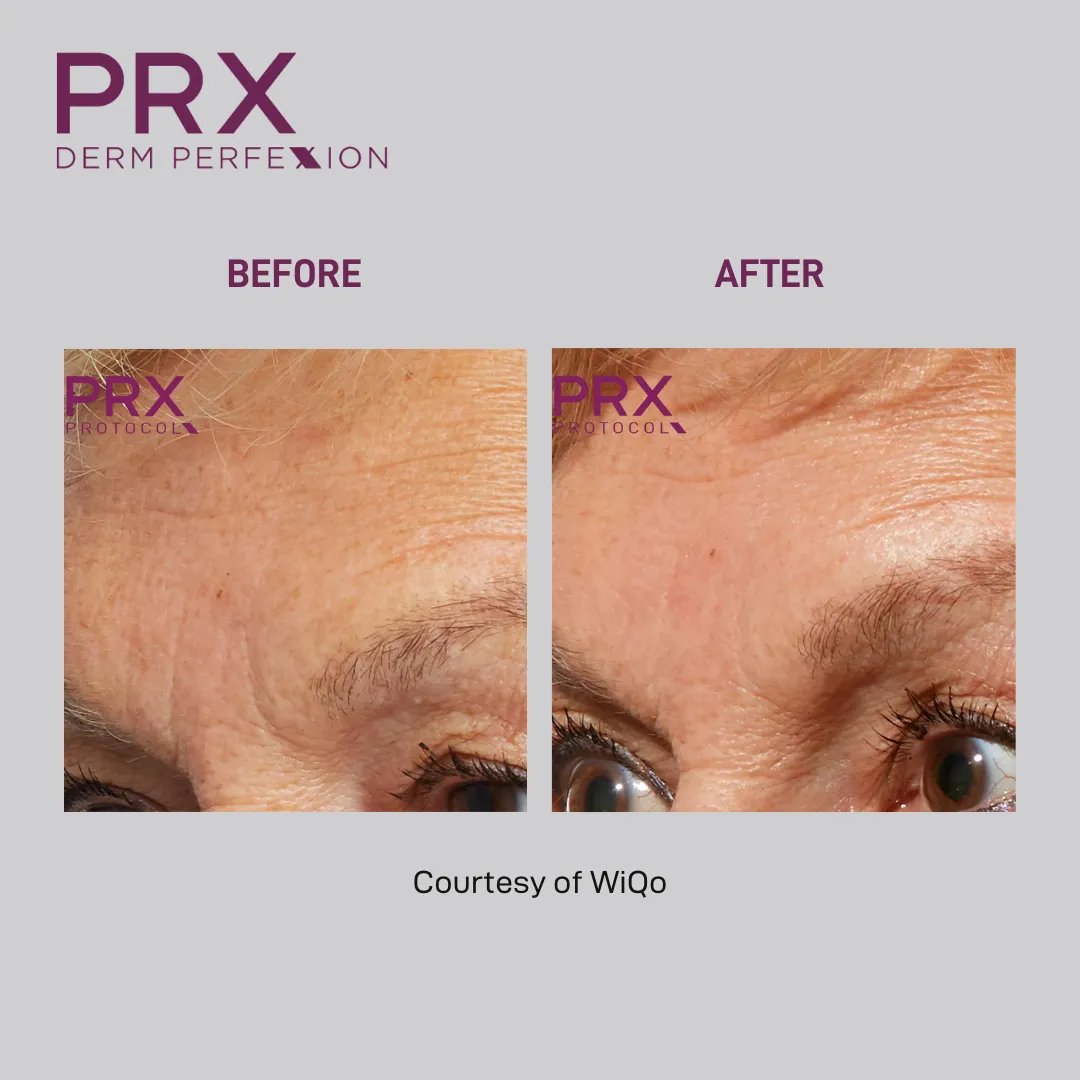 PRX Derm Perfexion before and after — forehead texture