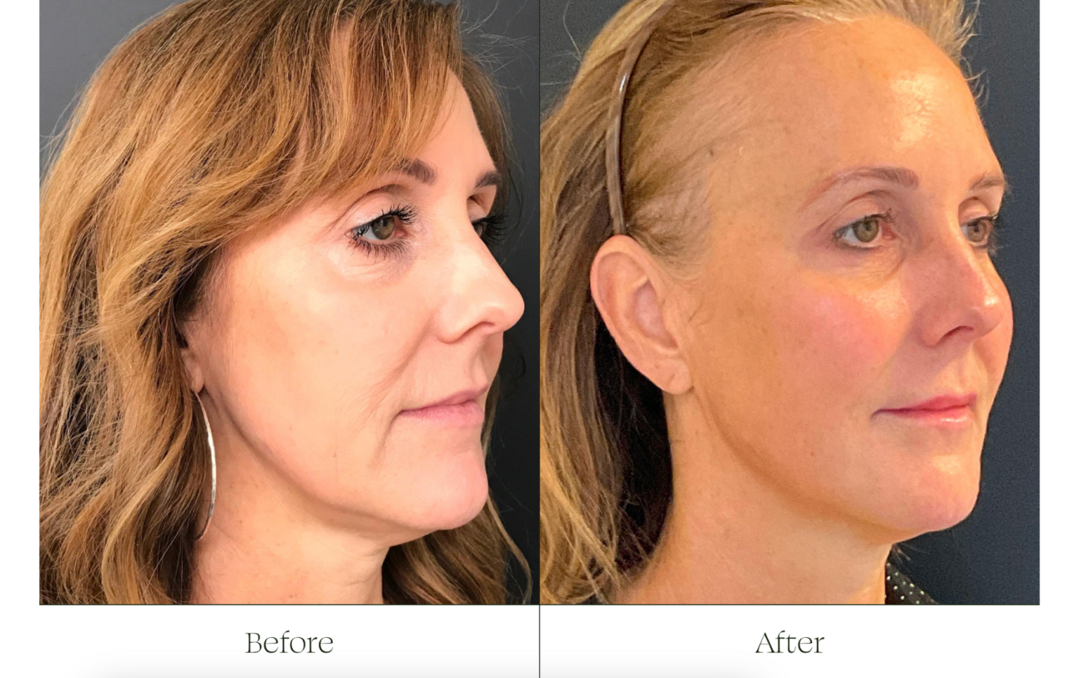 Sofwave facial lifting before and after results