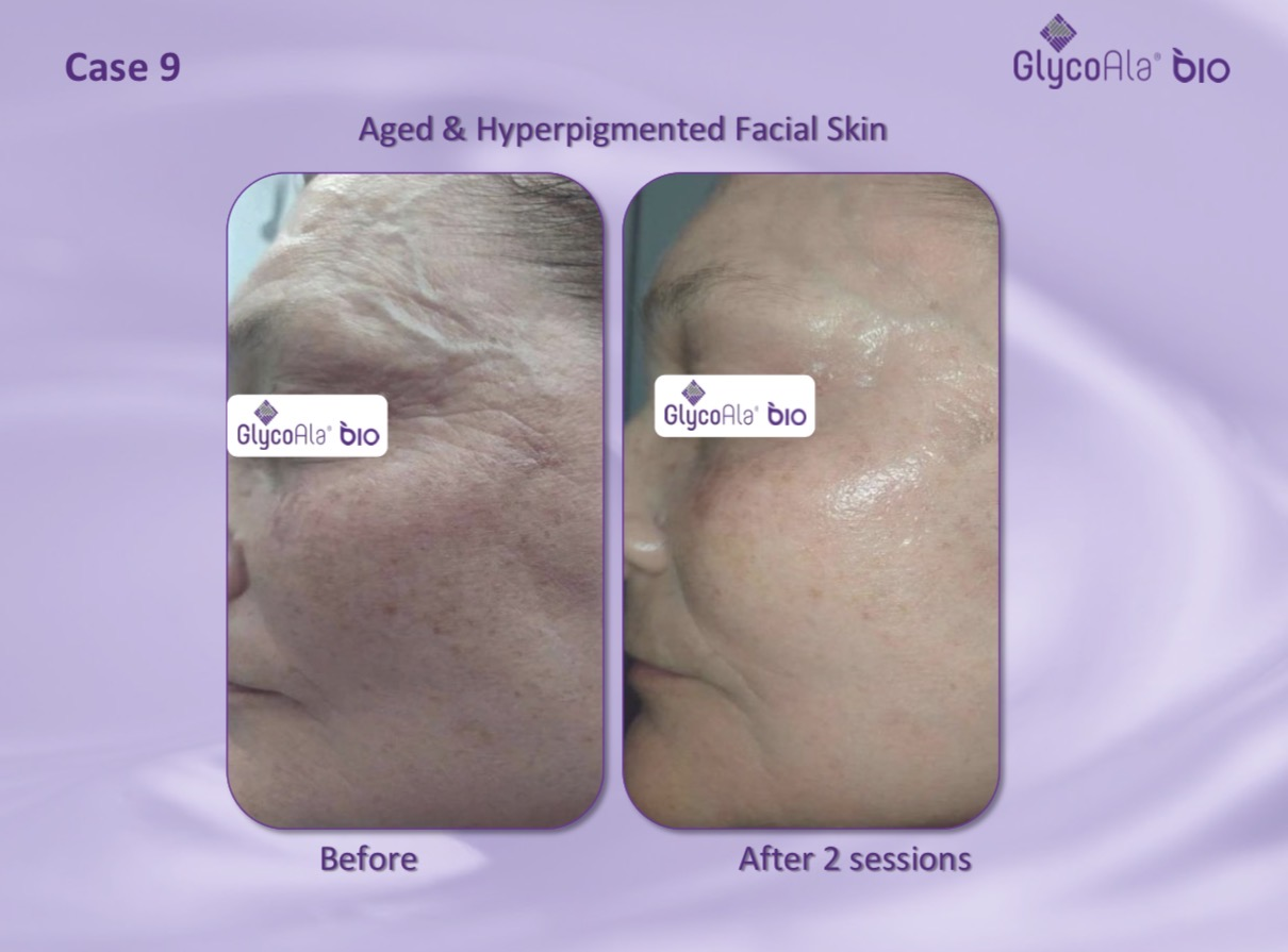 GlycoAla Bio before and after — aged and hyperpigmented facial skin after two sessions