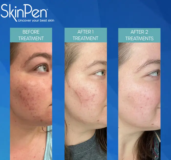 SkinPen before and after — 2 treatments, acne and texture improvement