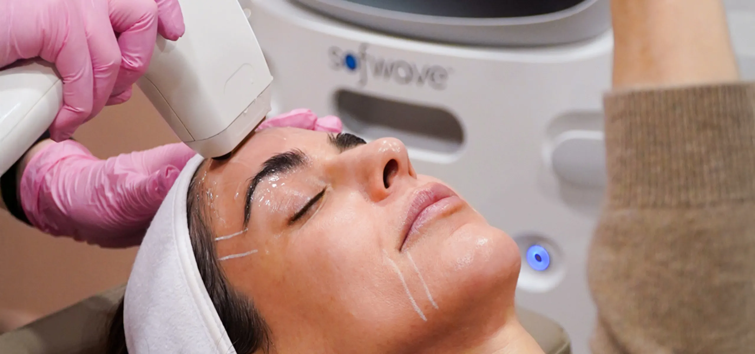 Sofwave treatment detail