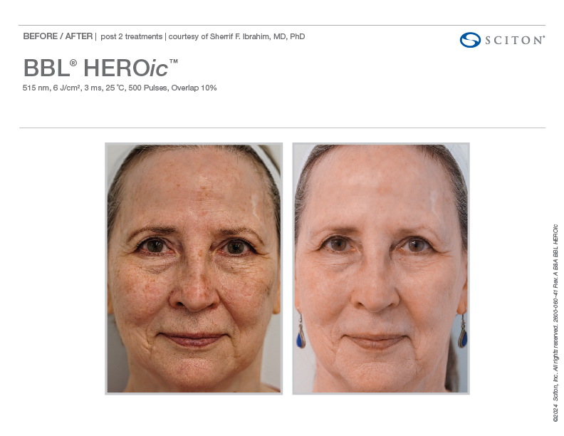 BBL HEROic before and after — facial pigment and tone correction