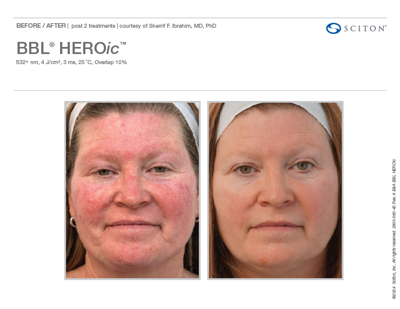 BBL HEROic before and after — redness and rosacea improvement