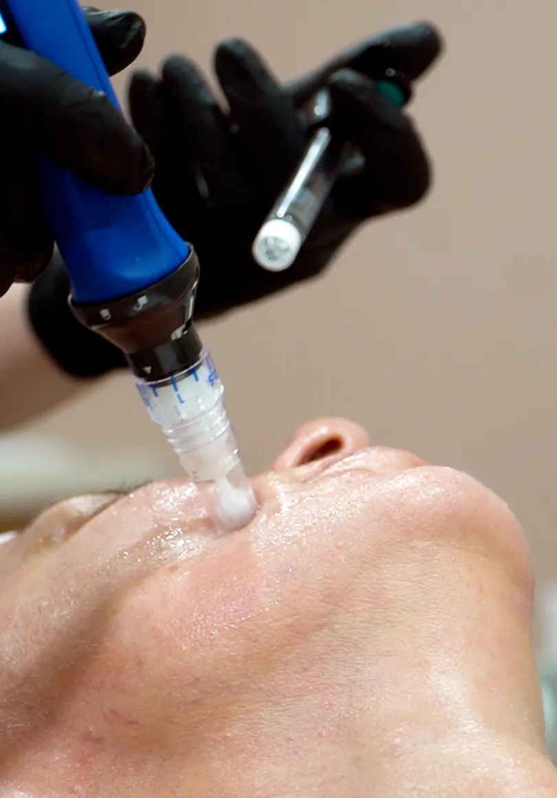 Close-up of SkinPen microneedling device on skin