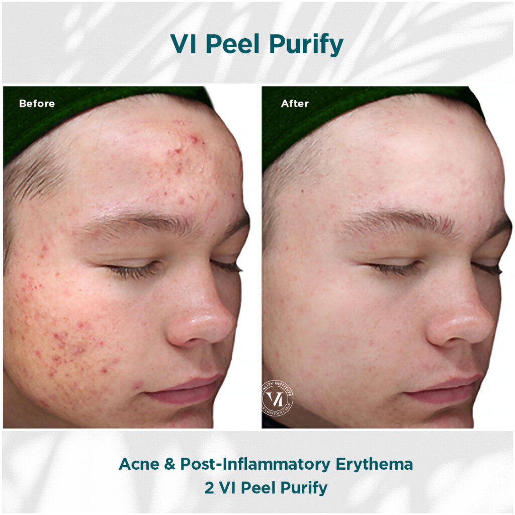VI Peel Purify before and after — acne & post-inflammatory erythema after 2 VI Peel Purify