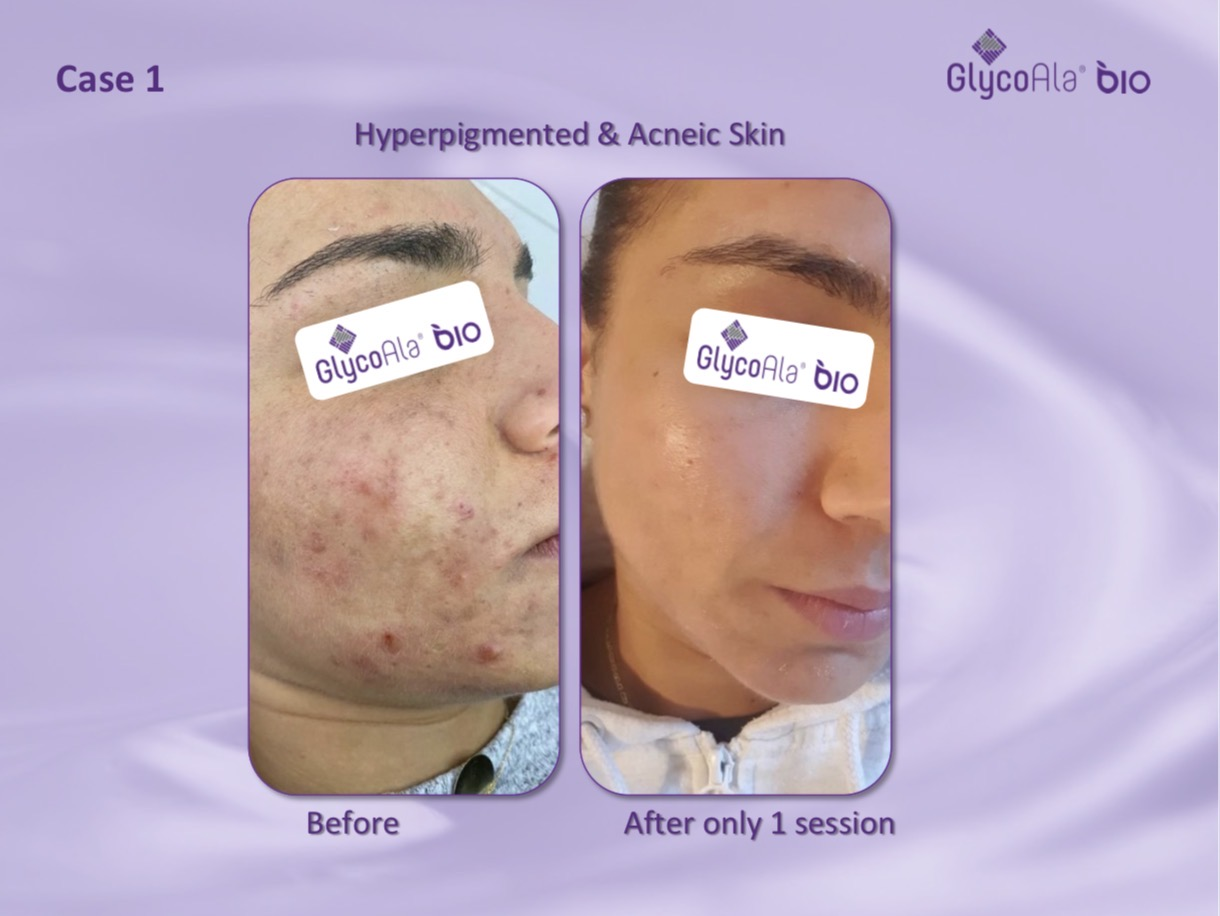 GlycoAla Bio before and after — hyperpigmented and acneic skin after one session