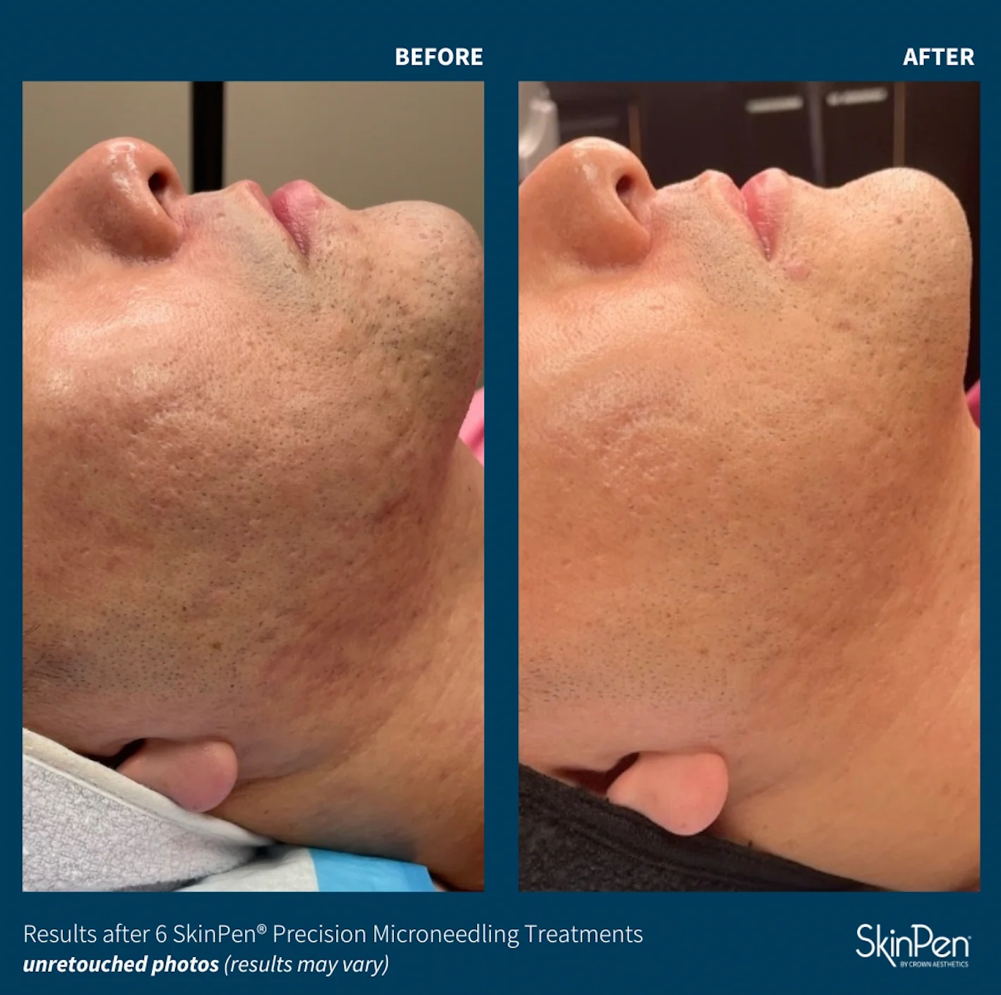 SkinPen before and after — 6 treatments, texture and scarring