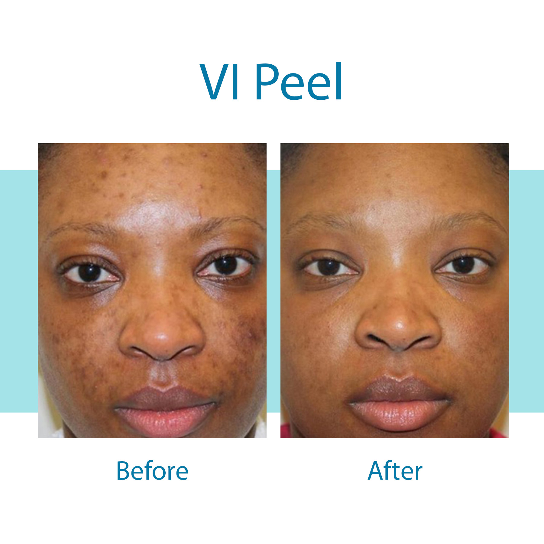 VI Peel before and after — pigmentation and clarity