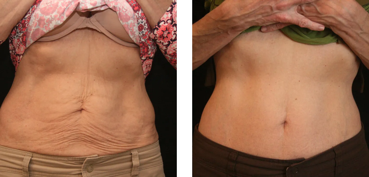 Sofwave abdomen skin tightening before and after results